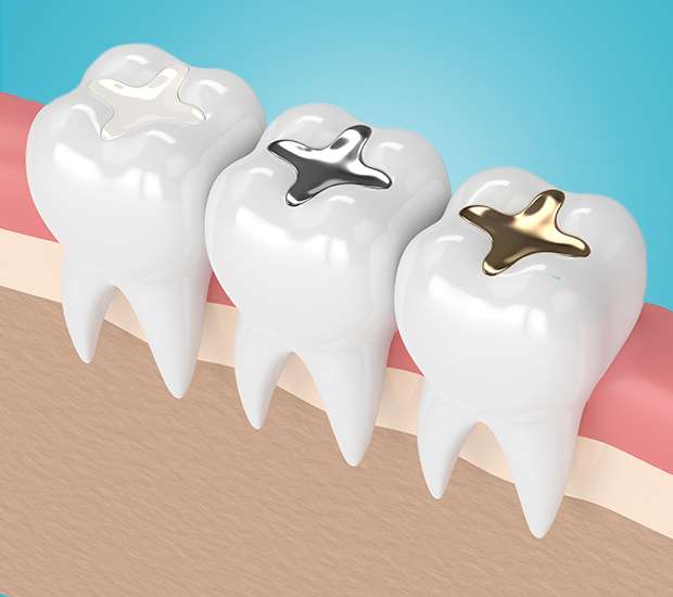 The Colony Composite Fillings