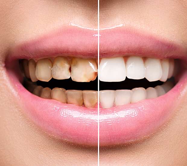 The Colony Dental Implant Restoration