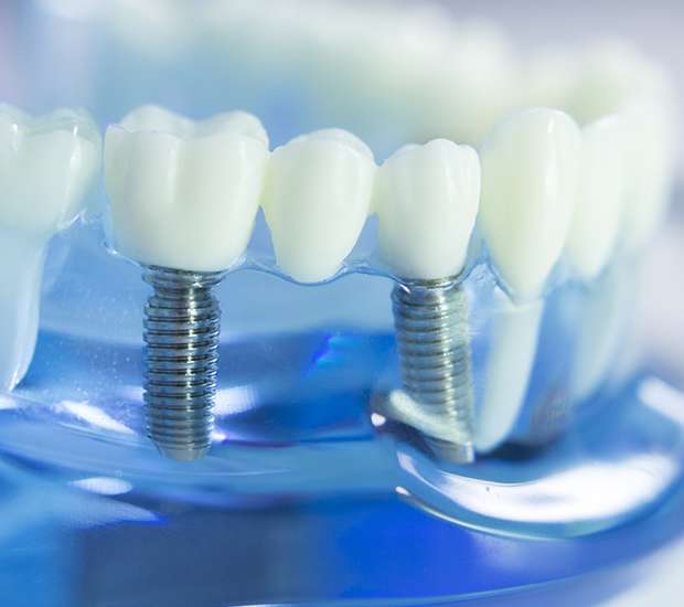 The Colony Dental Implants