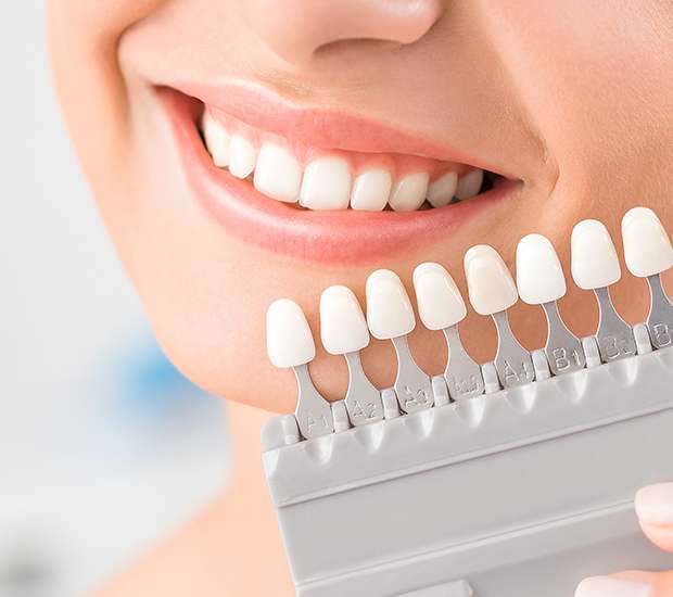 The Colony Dental Veneers and Dental Laminates