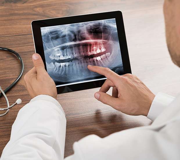 The Colony Types of Dental Root Fractures