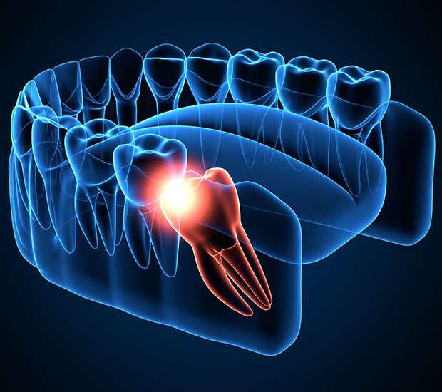 The Colony Wisdom Teeth Extraction